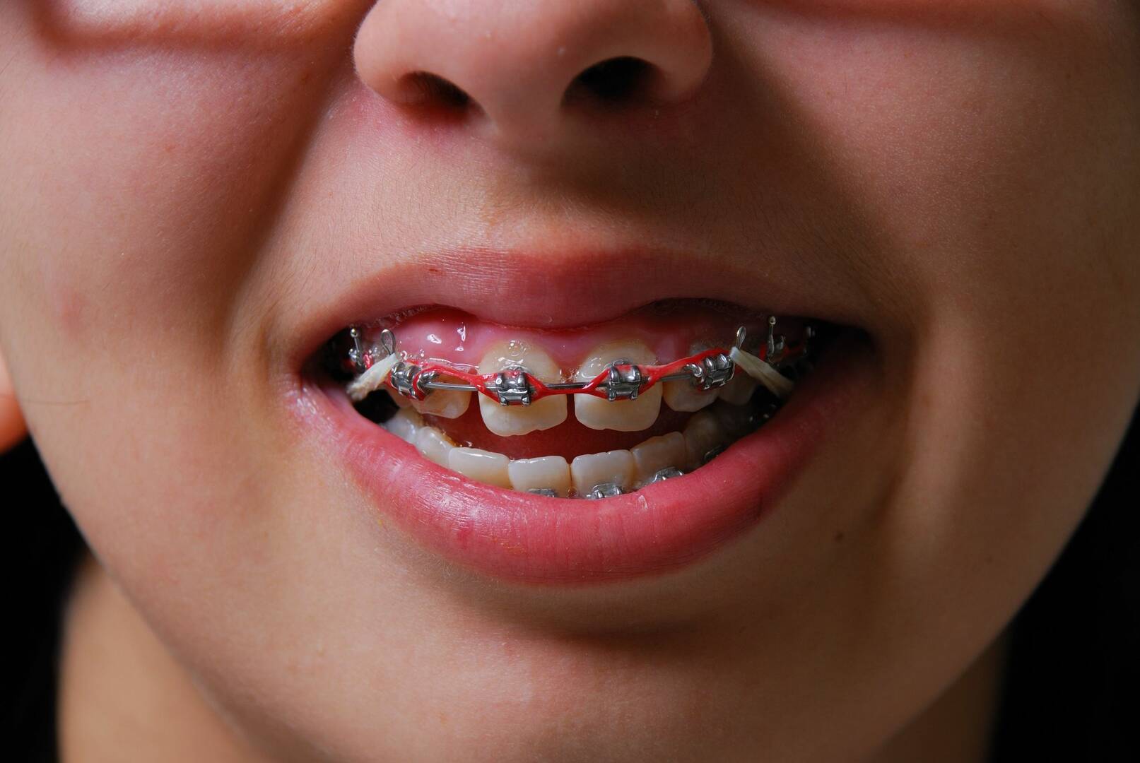 Dental Implants Troy MI
